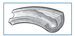 Drawing of a narrowed blood vessel.